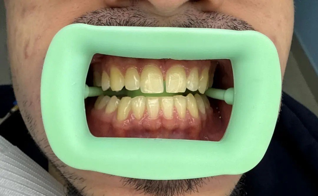 Before whitening treatment at Bhati Dental Clinic 